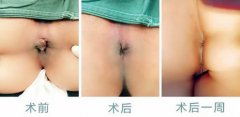 女性痔疮真人实拍图片 网上曝光7个小偏方能有效治痔疮